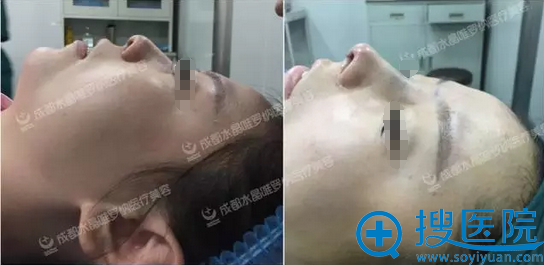 成都水晶唯罗纳隆鼻术后即刻效果 成都水晶唯罗纳隆鼻术后即刻效果