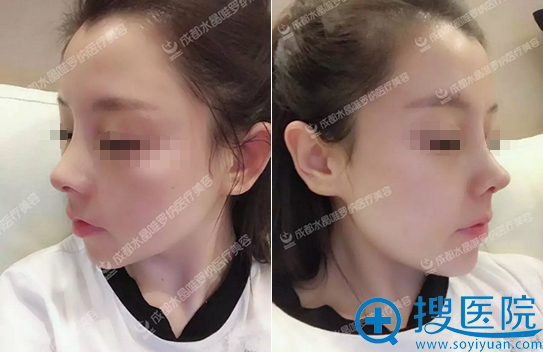 隆鼻术后5天拆线效果展示 隆鼻术后5天拆线效果展示