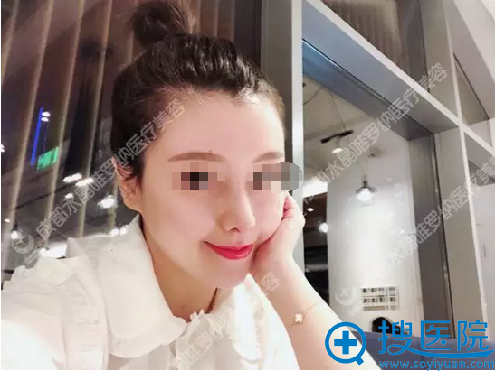 成都唯罗纳隆鼻术后10天恢复效果 成都唯罗纳隆鼻术后10天恢复效果