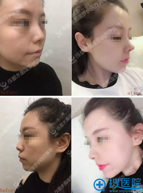 成都唯罗纳隆鼻术前术后对比图 成都唯罗纳隆鼻术前术后对比图