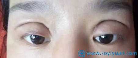 双眼皮做宽了将它变窄的办法 看张诚医生修复后的效果图