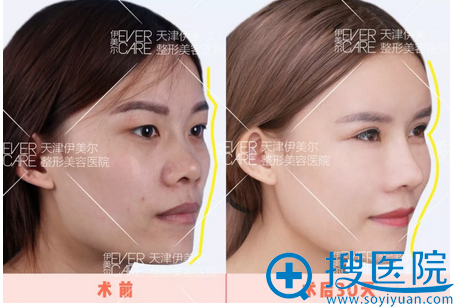 脂肪填充苹果肌案例 脂肪填充苹果肌案例