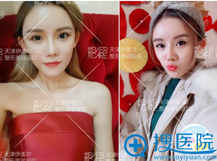 <!--<i data=20240710 data-id=12673></i>-->脂肪填充案例效果图 <!--<i data=20240710 data-id=12673></i>-->脂肪填充案例效果图