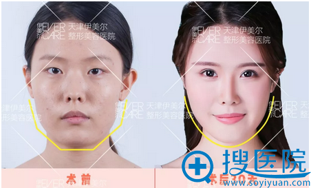 <!--<i data=20240710 data-id=12673></i>-->脂肪填下颌缘案例对比图 <!--<i data=20240710 data-id=12673></i>-->脂肪填下颌缘案例对比图