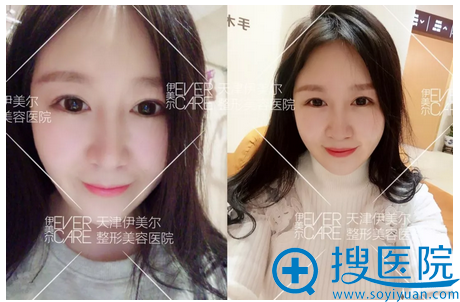 脂肪填充法令纹后的照片 脂肪填充法令纹后的照片