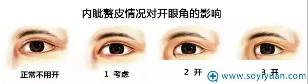 什么情况适合做开眼角手术 什么情况适合做开眼角手术