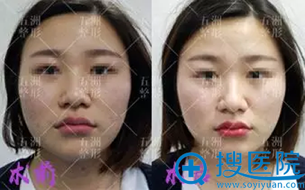 嗨体注射即刻效果对比图片 嗨体注射即刻效果对比图片