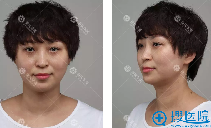 华美员工做隆鼻手术前 华美员工做隆鼻手术前