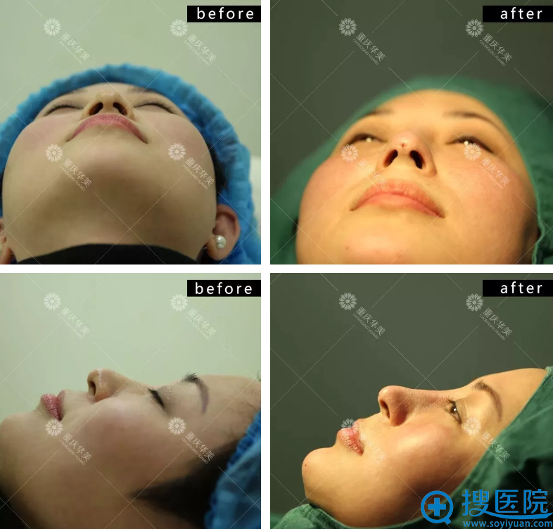 方医生做完线雕隆鼻手术即刻对比图 方医生做完线雕隆鼻手术即刻对比图