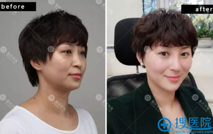 线雕隆鼻手术1天后效果对比图 线雕隆鼻手术1天后效果对比图