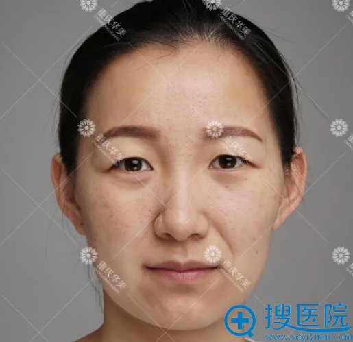 做双眼皮手术前的楠姐 做双眼皮手术前的楠姐