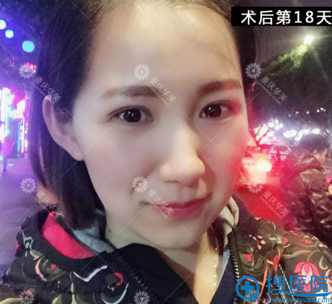 做双眼皮手术第18天恢复照 做双眼皮手术第18天恢复照