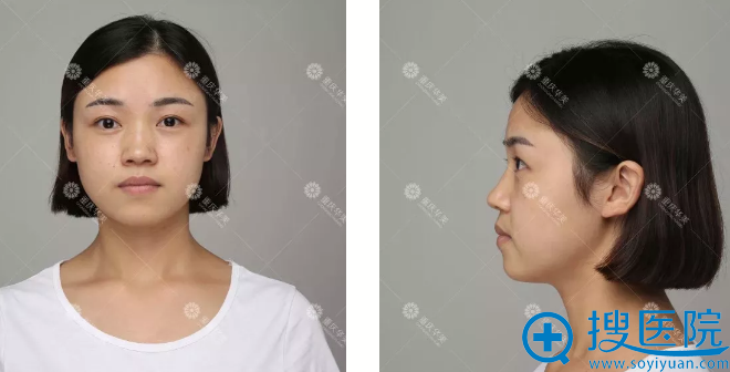 注射前的小妍希 注射前的小妍希