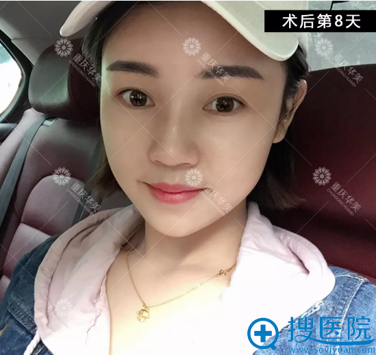 注射玻尿酸和8天恢复照 注射玻尿酸和8天恢复照