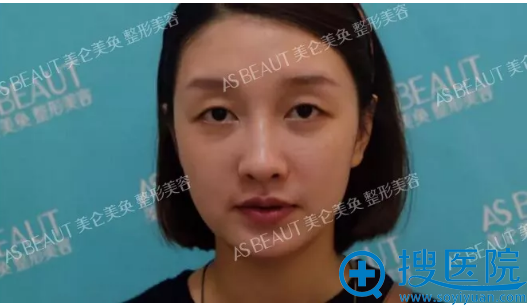 双眼皮术前照 双眼皮术前照