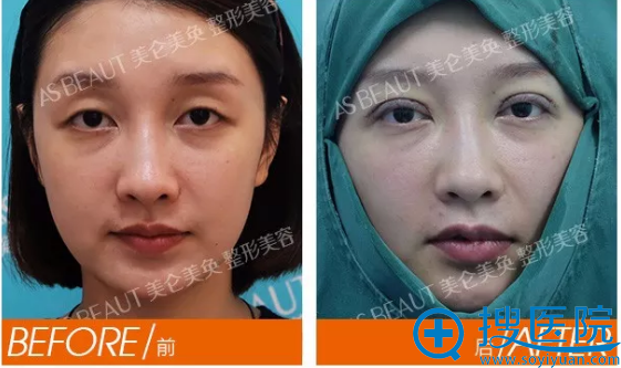 双眼皮前后对比图 双眼皮前后对比图