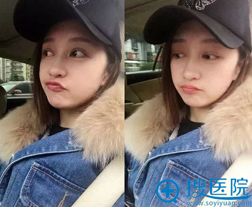 双眼皮半个月自拍,已经可以出来嗨了~ 双眼皮半个月自拍,已经可以出来嗨了~