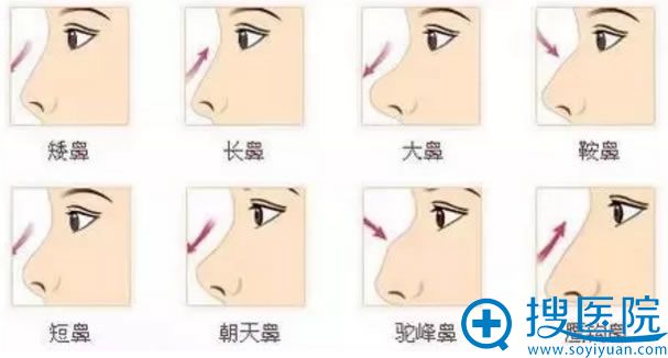影响侧面颜值的鼻型有哪些 影响侧面颜值的鼻型有哪些
