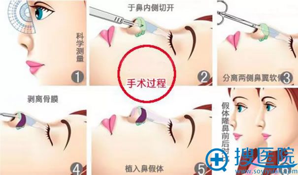 隆鼻手术过程示意图 隆鼻手术过程示意图
