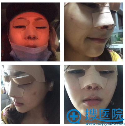 分享我的变美案例:找武汉五洲王金洲做了双眼皮隆鼻和脂肪填充