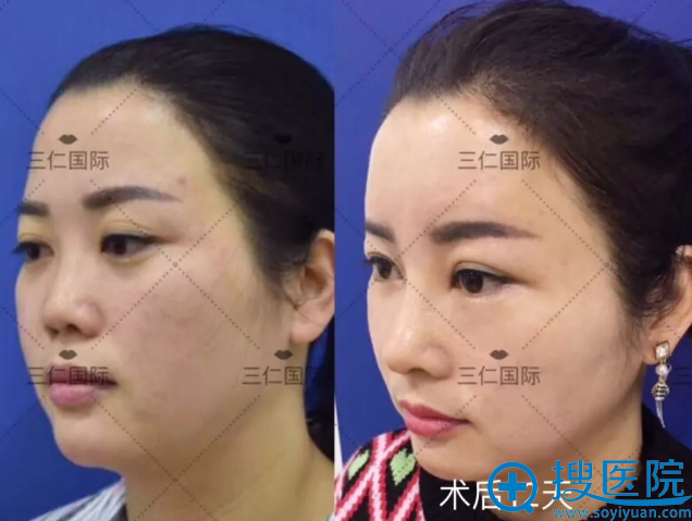 北京三仁鼻综合整形12天恢复效果 北京三仁鼻综合整形12天恢复效果