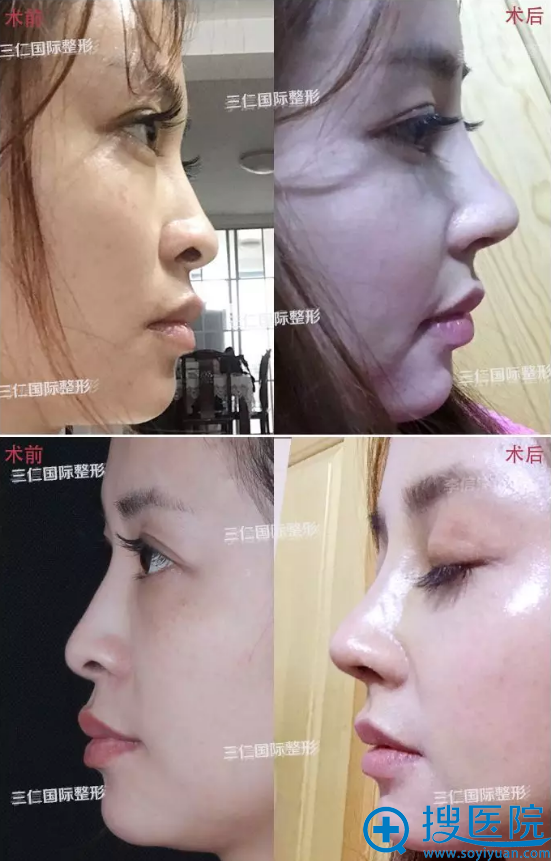 北京三仁鼻尖鼻梁综合整形案例 北京三仁鼻尖鼻梁综合整形案例