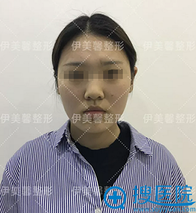 武汉伊美馨面部吸脂手术 我从大脸怪变小脸的秘密