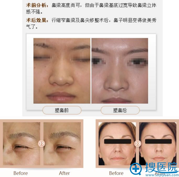 <!--<i data=20240710 data-id=8077></i>-->真人整形案例效果 <!--<i data=20240710 data-id=8077></i>-->真人整形案例效果