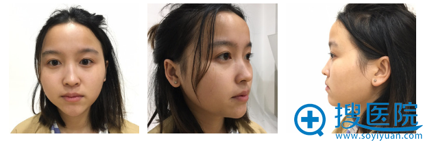 看我在妈妈陪同下找宁波壹加壹整形医院郭光烨做的隆鼻好看吗