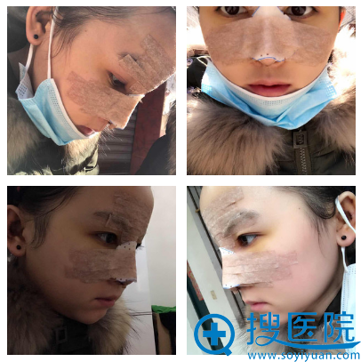 隆鼻第5天恢复情况 隆鼻第5天恢复情况
