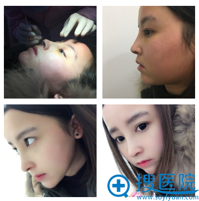 鼻综合8天拆线效果 鼻综合8天拆线效果