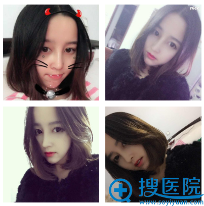 郭光烨隆鼻半个月自拍 郭光烨隆鼻半个月自拍