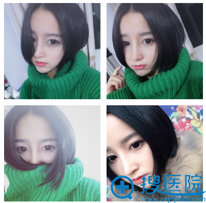 鼻综合一个月恢复效果图 鼻综合一个月恢复效果图