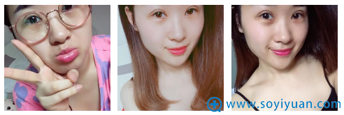 双眼皮第4天恢复情况 双眼皮第4天恢复情况