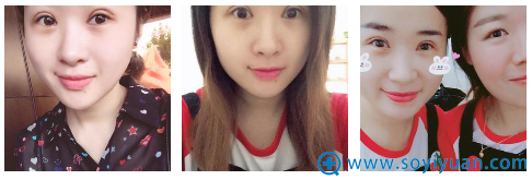 双眼皮第5天和同事的合影 双眼皮第5天和同事的合影