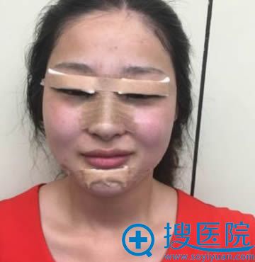 做完假体隆鼻和隆下巴后的照片 做完假体隆鼻和隆下巴后的照片
