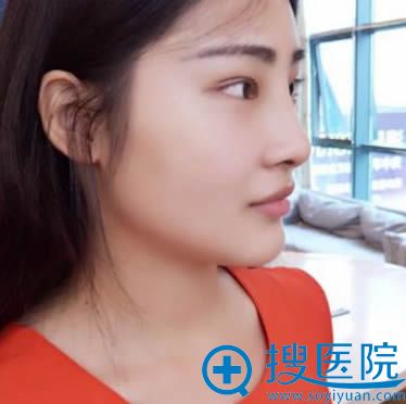 杨国正院长为我做完双眼皮和隆鼻术后15天恢复效果 杨国正院长为我做完双眼皮和隆鼻术后15天恢复效果