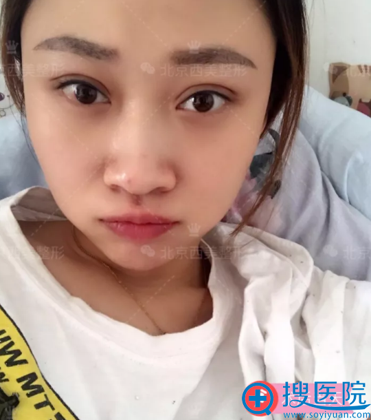 做完双眼皮手术的我 做完双眼皮手术的我