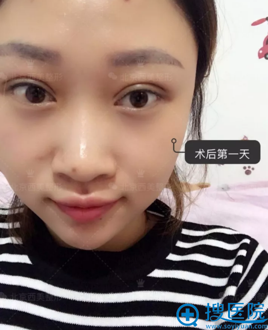 <!--<i data=20240710 data-id=7853></i>-->做双眼皮手术第1天效果 <!--<i data=20240710 data-id=7853></i>-->做双眼皮手术第1天效果