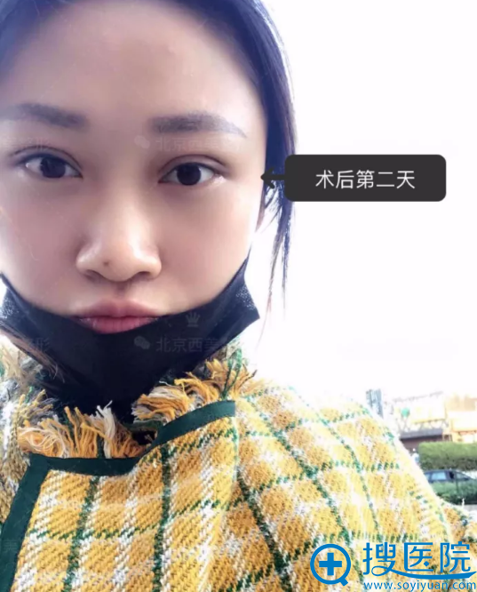 在西美做完双眼皮手术第2天 在西美做完双眼皮手术第2天