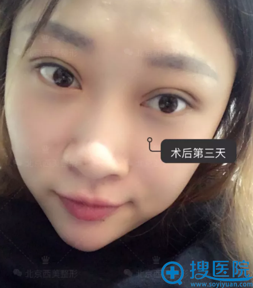 <!--<i data=20240710 data-id=7853></i>-->双眼皮手术第3天 <!--<i data=20240710 data-id=7853></i>-->双眼皮手术第3天