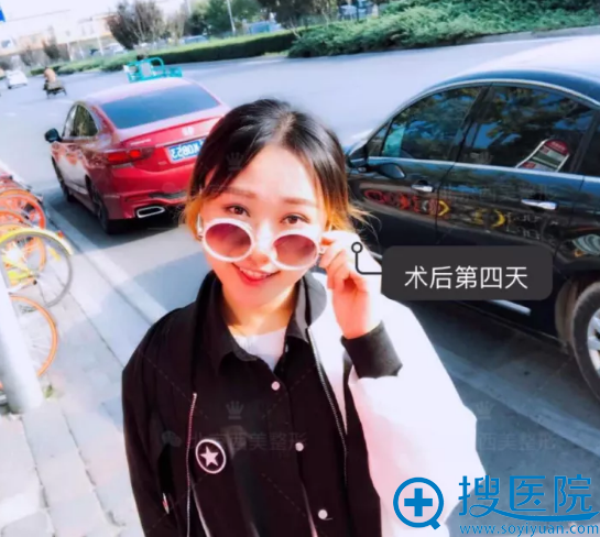 双眼皮手术第4天恢复照片 双眼皮手术第4天恢复照片