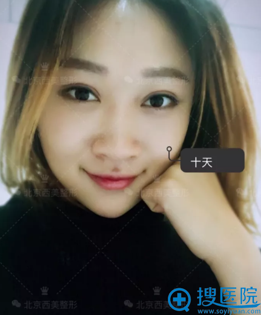 <!--<i data=20240710 data-id=7853></i>-->双眼皮10天恢复图片 <!--<i data=20240710 data-id=7853></i>-->双眼皮10天恢复图片