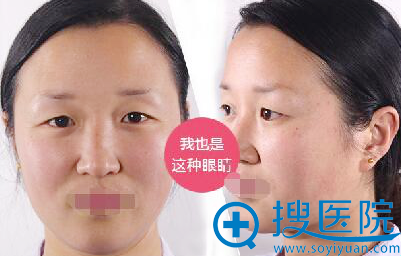 双眼皮弧线不对称 一大一小、一高一低 双眼皮弧线不对称 一大一小、一高一低
