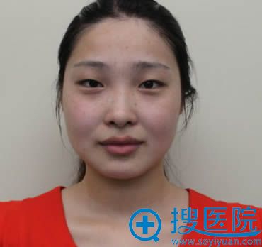 在<!--<i data=20240710 data-id=12781></i>-->整形医院做双眼皮和隆鼻前的样子 在<!--<i data=20240710 data-id=12781></i>-->整形医院做双眼皮和隆鼻前的样子