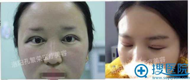 术后第二天已经很美了有木有 术后第二天已经很美了有木有