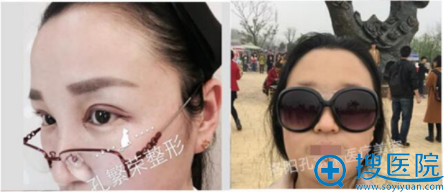 术后第三天迫不急待的出来晒晒 术后第三天迫不急待的出来晒晒