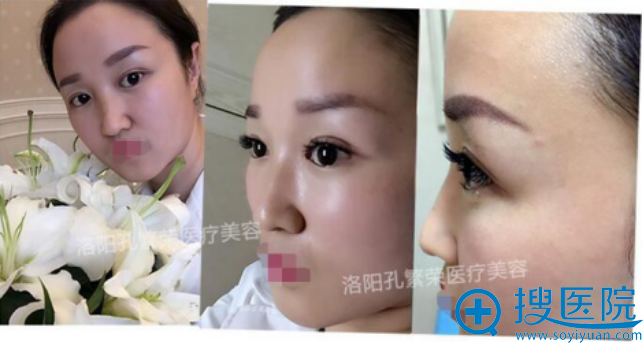 术后7天我的眼睛已经很自然了吧 术后7天我的眼睛已经很自然了吧