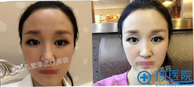 Look一下完全消肿的我有没有很美 Look一下完全消肿的我有没有很美