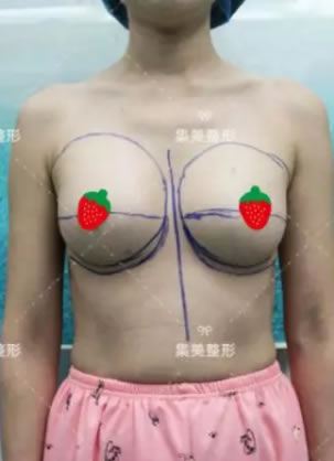 婚后5年做过2次假体隆胸什么感受 集美陈曦医生胸部修复案例